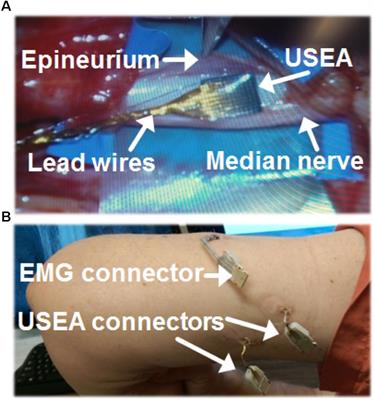 Motor Control and Sensory Feedback Enhance Prosthesis Embodiment and Reduce Phantom Pain After Long-Term Hand Amputation